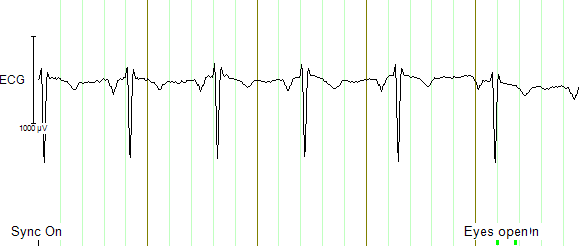 ../_images/SOP_eeg20.png